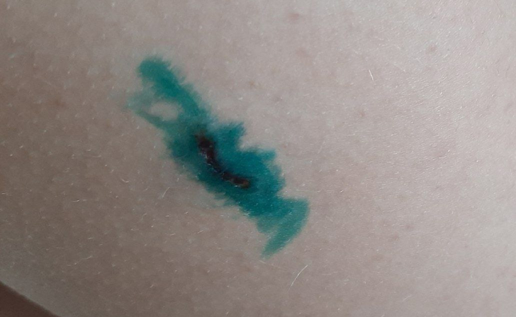 В Курске подростка укусила бездомная собака