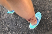 В комитете здравоохранения прокомментировали нападение собак на двух курянок